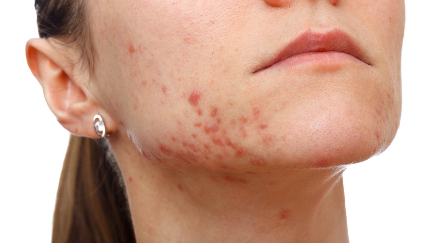 laser acne treatment melbourne